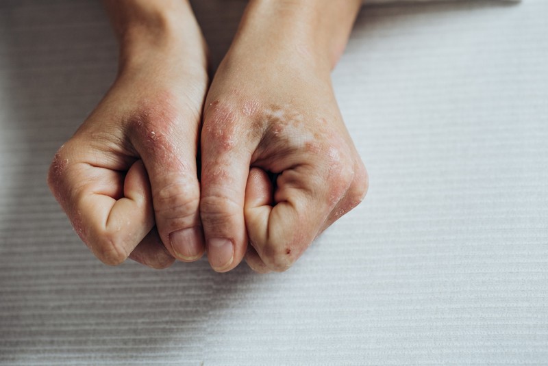 Mitől alakul ki a pikkelysömör?