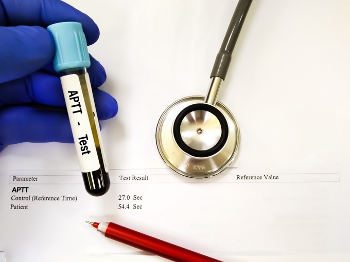 Mit jelent az APTT érték a laborleleten? című cikk nyitóképe