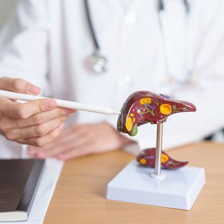 Hogyan gyógyítható a zsírmáj? Ezeket a tanácsokat érdemes betartania című cikk nyitóképe