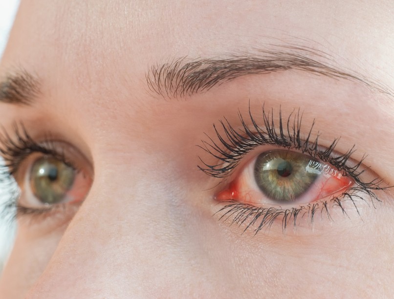 szemfájdalom, szempirosság, glaukóma, zöldhályog