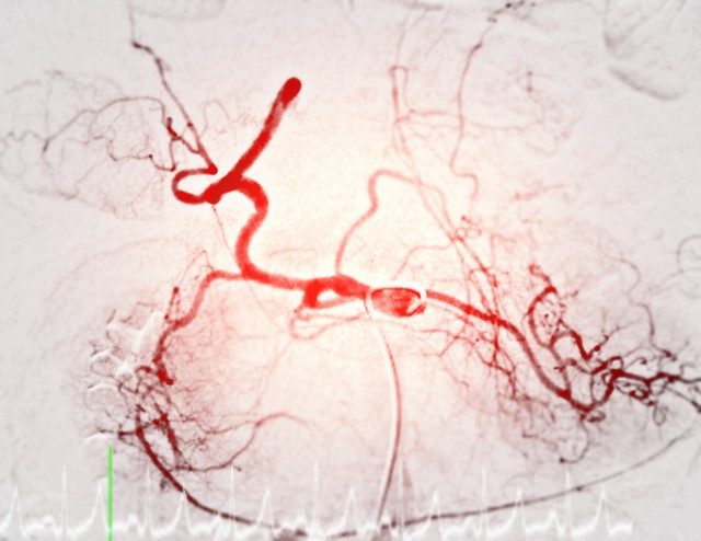 Mi az arteriográfia és mit mutat ki?