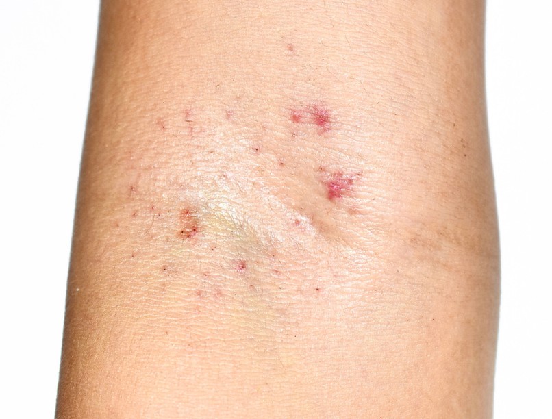 bőr folt dudor csomó oka leukémia tünete