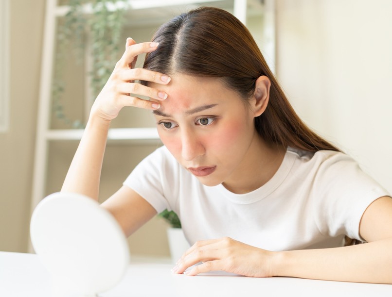 pillangó arc bőr bőrpír arcpír oka autoimmun betegség tünete lupus