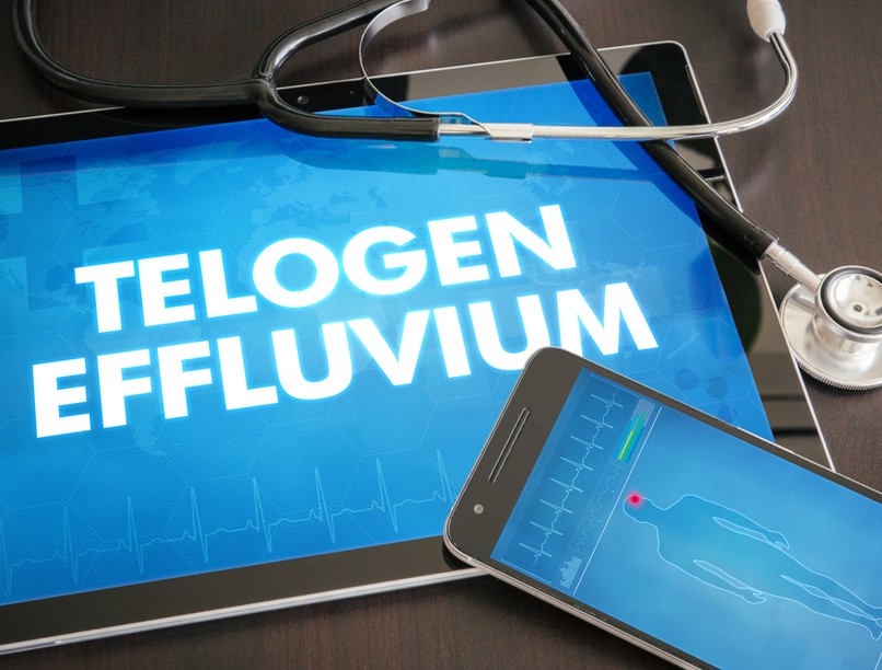 hajhullás, telogén effluvium, oka, tünetei, kezelése, telogén hajhullás, kopaszodás, hajszálak, stressz, tápanyaghiány