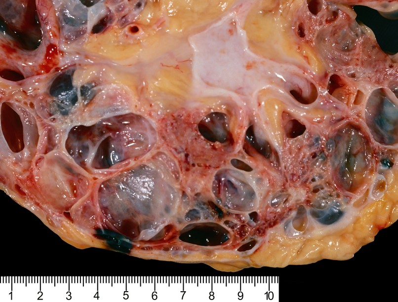 Policisztás vesebetegség tünet vizsgálat kezelése