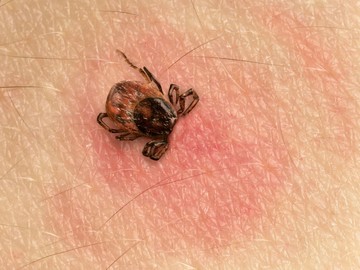 Lyme-kór: ezek a kullancscsípés utáni első tünetek