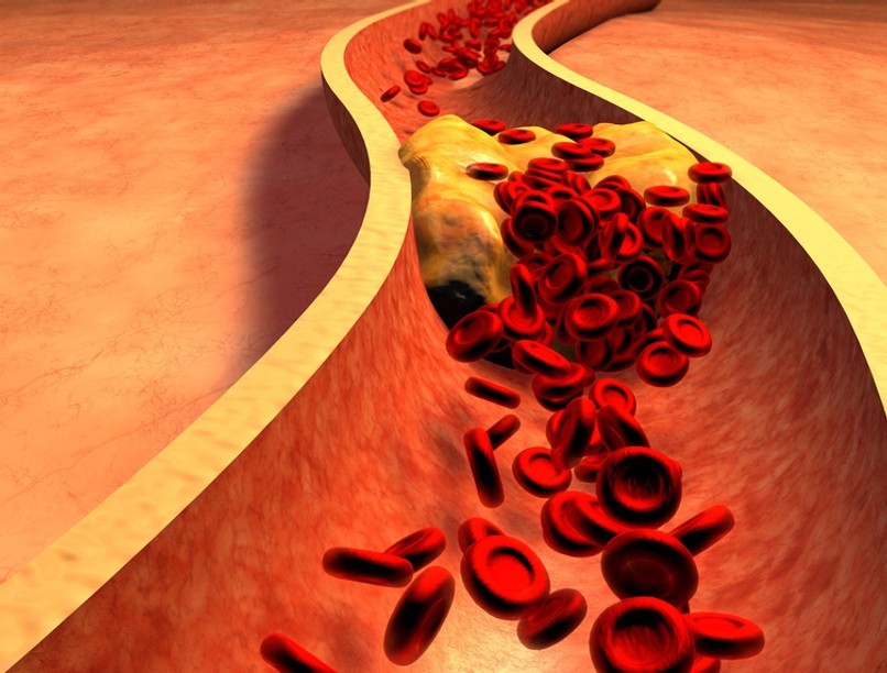koleszterinszint, koleszterin, magas koleszterin, szívbetegség, trombózis, stroke, szívinfarktus, infarktus