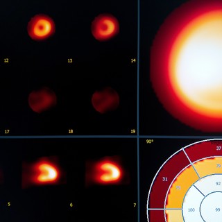 Mi a szkintigráfia és mit mutat ki? című cikk nyitóképe