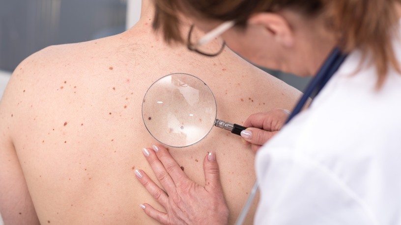 bőrrák, daganat, melanoma, anyajegy