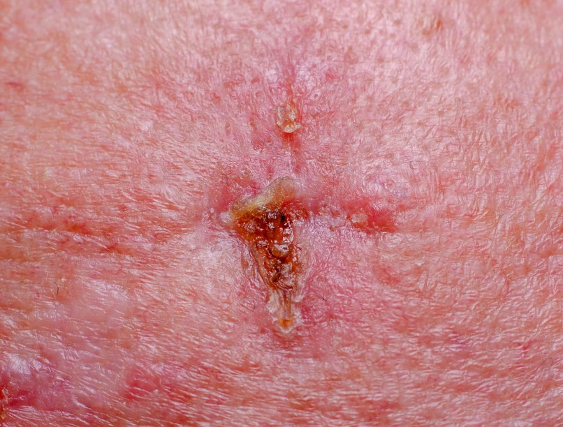 basalioma, bőrrák, tünet, jele bőrelváltozás, daganat