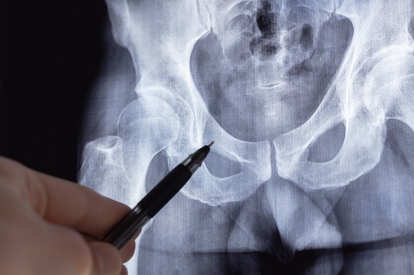 A Paget-kór egy olyan állapot, amely két fő formában létezik: az egyik a csontanyagcsere rendellenessége (osteitis deformans), ami a csontok törékennyé és deformálódottá tételét okozza, leggyakrabban a medencében, koponyában, gerincben és lábakban; a másik a bőr, emlő vagy nemi szervek Paget-kórja, amely a hámsejtek kóros elburjánzása, gyakran egy alapuló daganat jele, és nem gyógyuló sebeket, kiütéseket, viszketést és váladékozást okoz. A diagnózis fizikális vizsgálattal, biopsziával (szövettani mintavétel), képalkotó vizsgálatokkal (röntgen, CT, MRI) és vérvizsgálattal (alkalikus foszfatáz szint) történik, a kezelés pedig a tünetek és a forma függvénye.