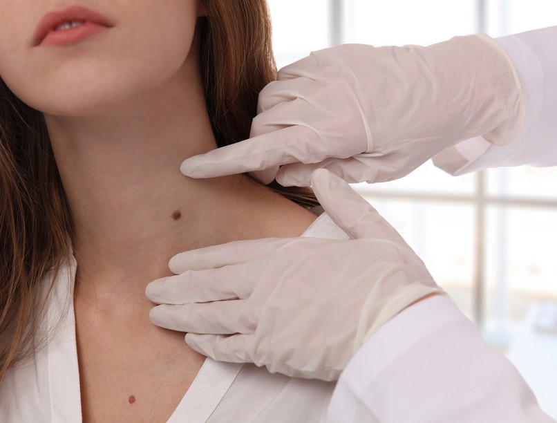 Mire való a teljes testtérképes anyajegyszűrés