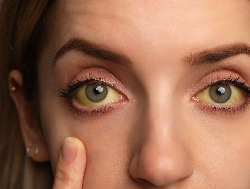 epekő tünete szövődményes epe