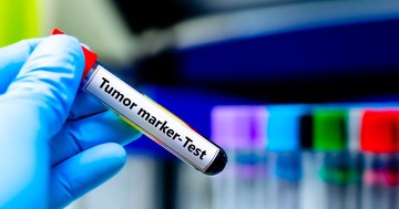  PSA, CA-125, CEA – Vajon mit jelentenek a leggyakoribb tumormarkerek? 