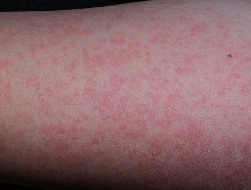 lepkehimlő, gyerek, tünet