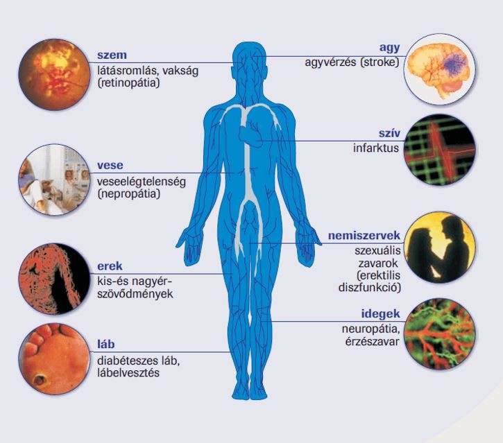 A cukorbetegség szövődményei