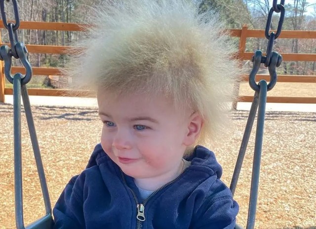 Fésülhetetlen haj szindróma: ennek a kisfiúnak különleges hajszálai vannak