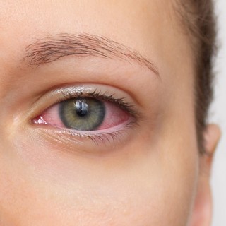 Kötőhártya-gyulladás tünetei - ebből tudhatja, ha fertőző című cikk nyitóképe