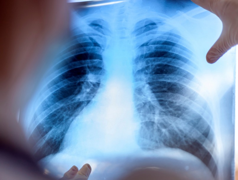 mitől lehet árnyék a tüdőn