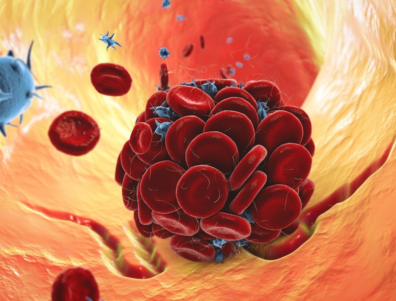 trombózis trombofília hajlam jele tünet