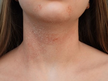 Mi okozza az atópiás dermatitiszt és hogyan kezelhető? Erről jó, ha tud!