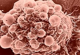 Orvosi siker lehet: nanorészecskékkel - a daganatok ellen