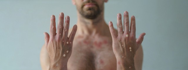 Majomhimlő: már 13 ezernél is többen elkapták az USA-ban