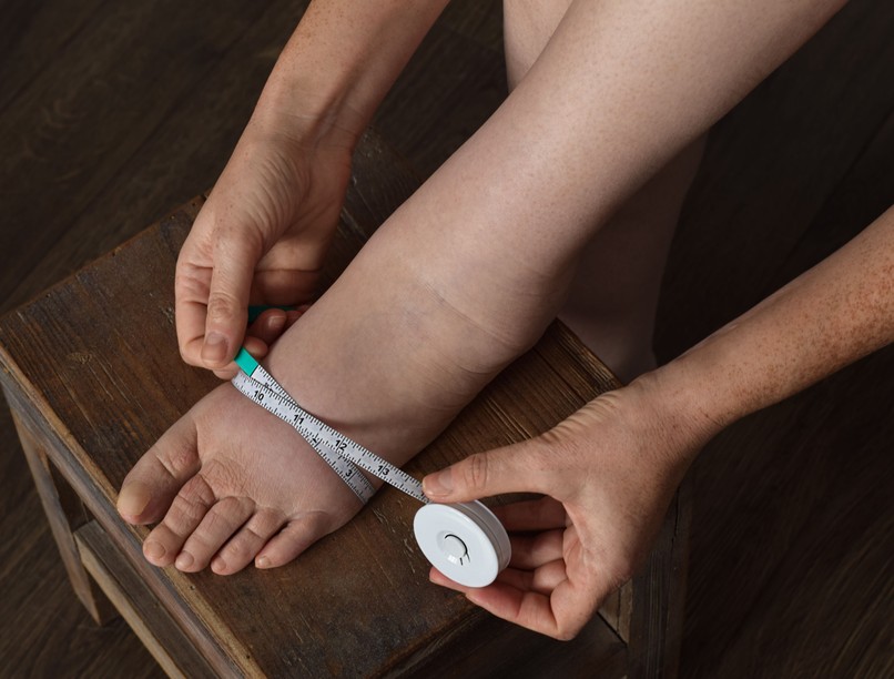 püffedt vizes láb oka jele nyiroködéma tünete