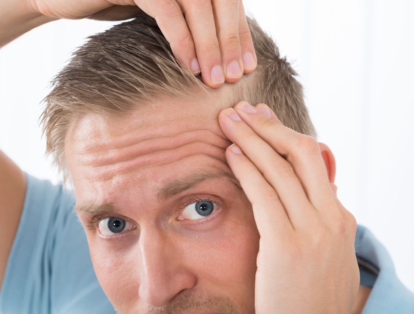 férfi hajhullás kopaszodás tesztoszteron termékenység meddőség