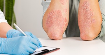 Pikkelysömör: ezekben a pszoriázis centrumokban kezelik ingyenesen