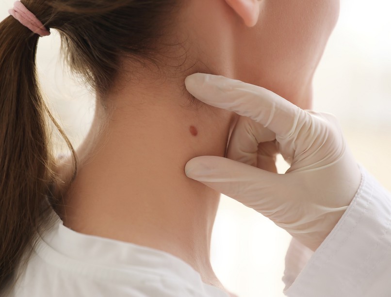 melanóma bőrrák áttét mikor orvos