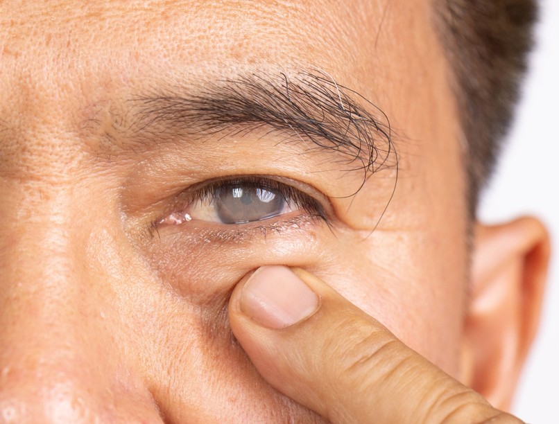 szürkehályog tünet vizsgálat kezelés