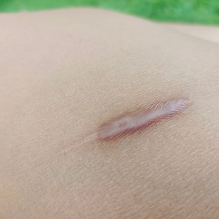 Keloid: tünetei, vizsgálata és kezelési lehetőségei című cikk nyitóképe