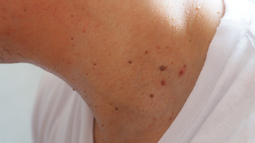borkinoves-fibroma-nyak-honalj-oka