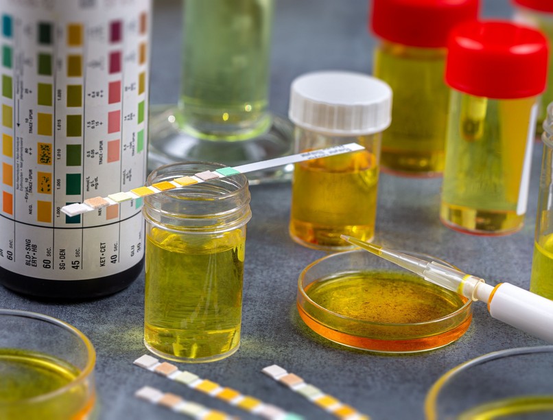 vizelet, vizsgálat, genny, baktérium