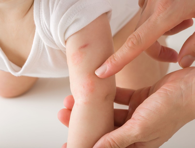 Mi okozhat kiütéseket a csecsemő bőrén pirosság