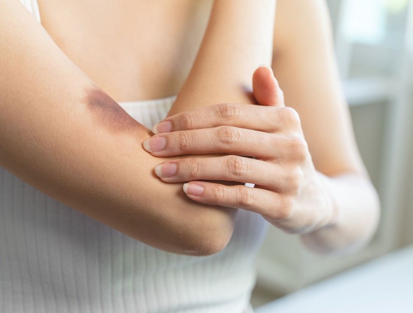 Zúzódások tünet vizsgálat kezelés