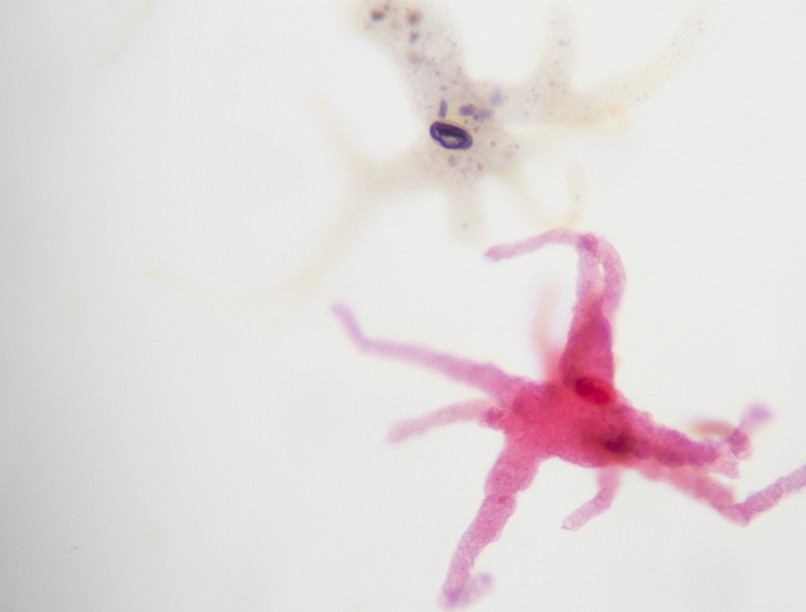 amőba, fertőzés, Balamuthia mandrillaris, antiboitikum, húgyúti gyógyszer