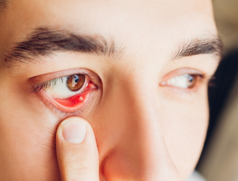 belső árpa tünete kezelése szemen szemárpa tünetei