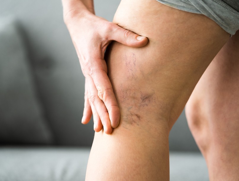 trombózis, vérrög, erek, visszér