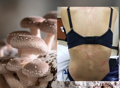 Mintha megkorbácsolták volna: furcsa kiütések jelentek meg egy nő hátán miután shiitake gombát evett című cikk nyitóképe