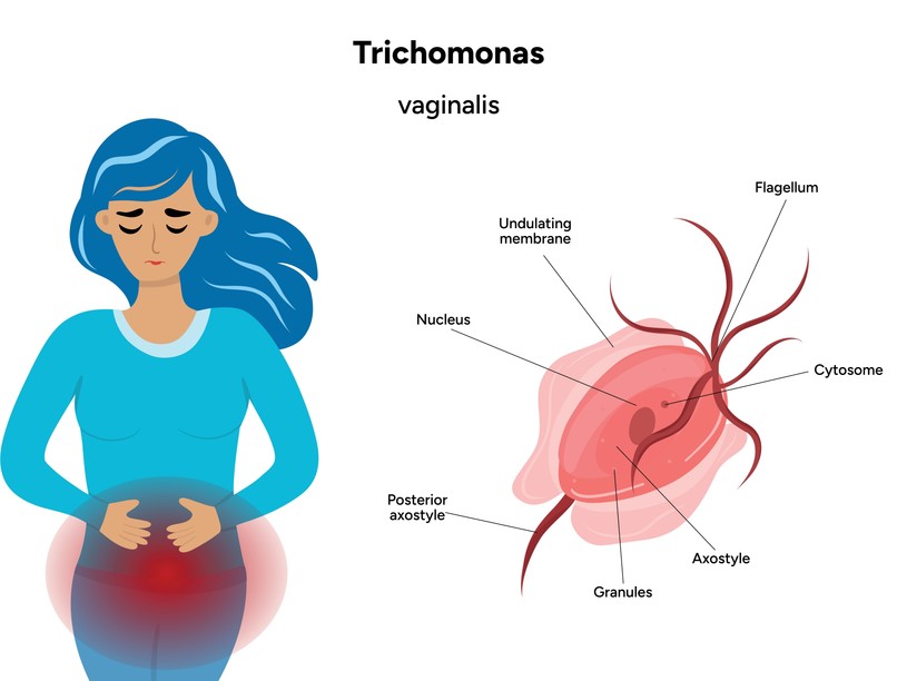 Trichomonas-fertőzés tünet vizsgálat kezelés