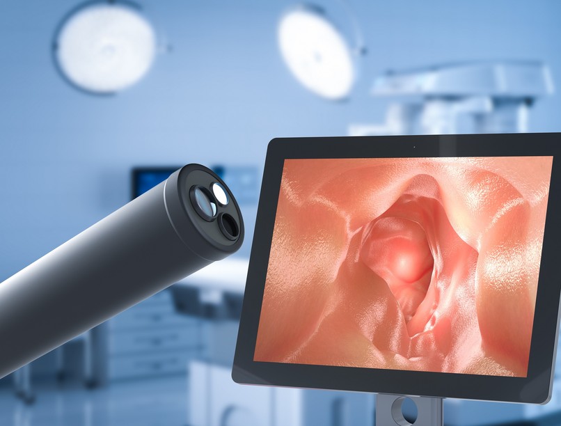 kezeletlen fekély vastagbélgyulladás tumor rák következmény