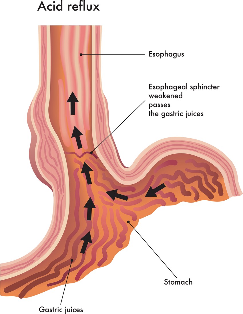 A gastrooesophageális refluxbetegség (GERD) is okozhat rekedtséget. Ekkor a gyomor savtartalma a nyelőcsőbe távozik, ez a sav pedig a hangszalagokat irritálhatja és rekedtséget okoz.
