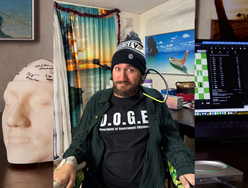 Elon Musk chip beültetés agy