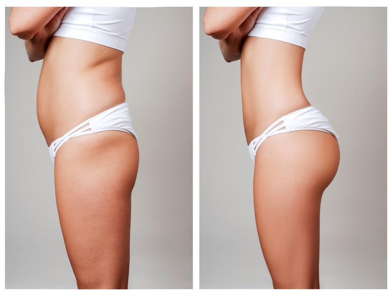 zsírárna, zsíleszívás, zsír. háj, gyors megoldás