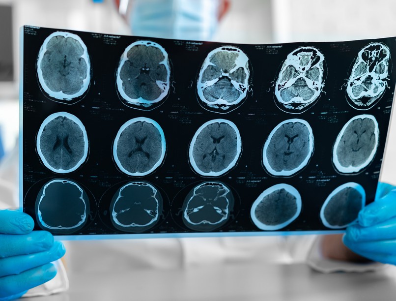 agyi ödéma felszívódási ideje