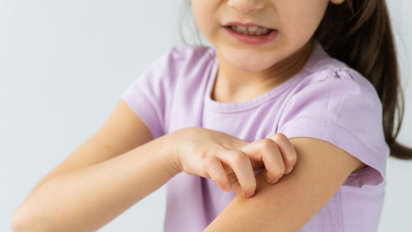atópiás dermatitisz bőrgyulladás viszketés