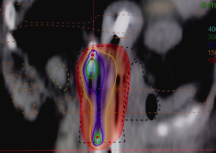Az onkológiai sugárterápia egy hatékony és elterjedt módszer a rák kezelésére, és számos életet mentett meg az évek során.