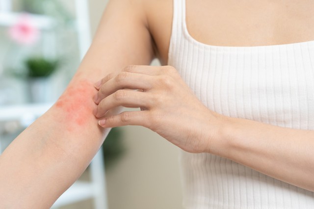 Ha ilyen folt jelenik meg a bőrén, azonnal menjen orvoshoz, gyógyszer mellékhatása is lehet!